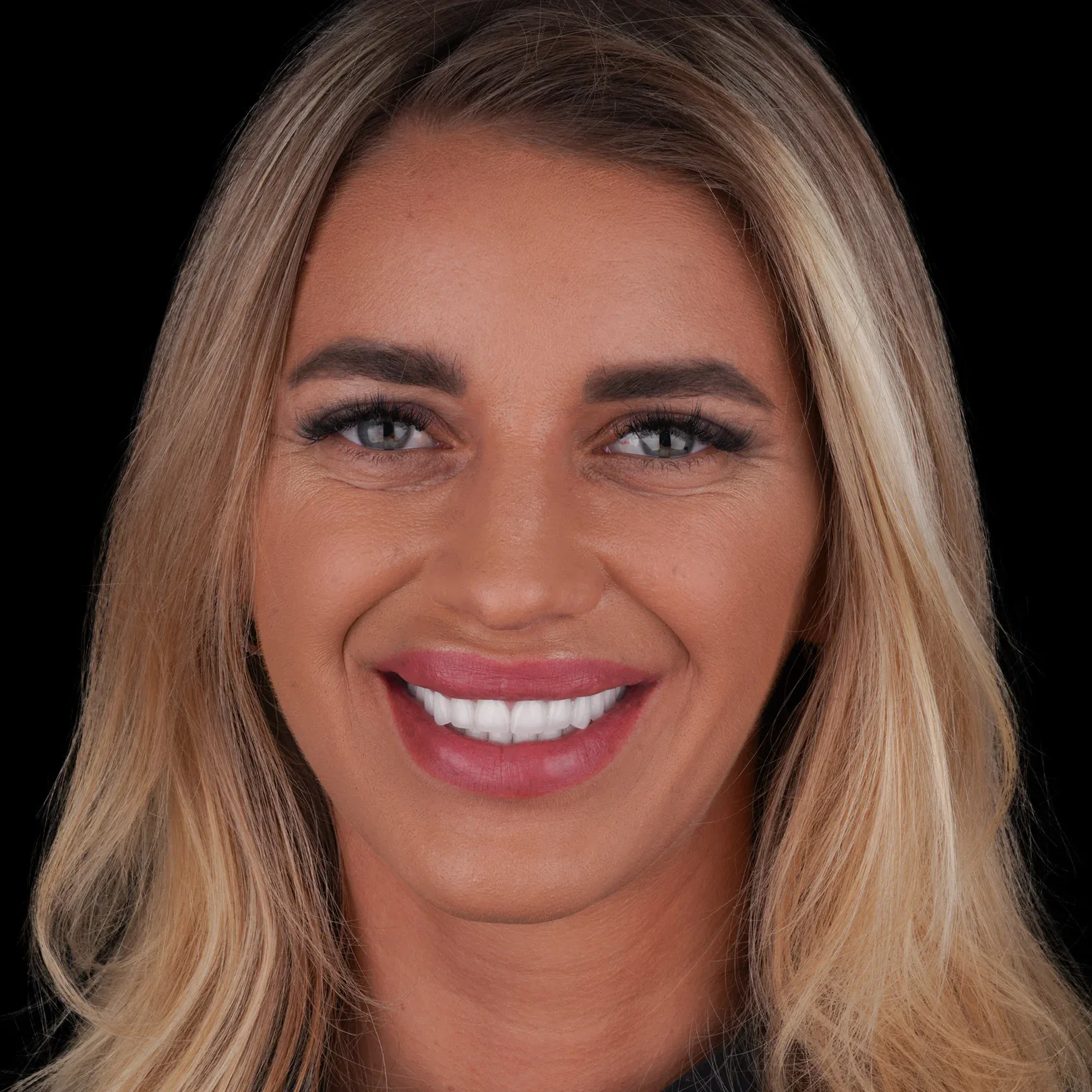 hollywood-smile-before-after-38 hollywood smile before after 38