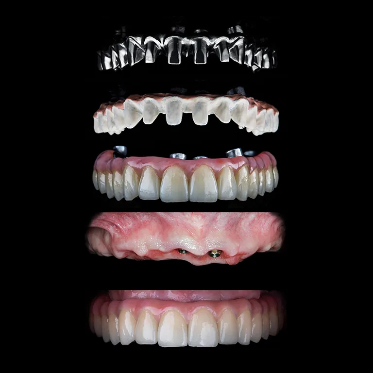 Toronto Dental Bridge (Before After)