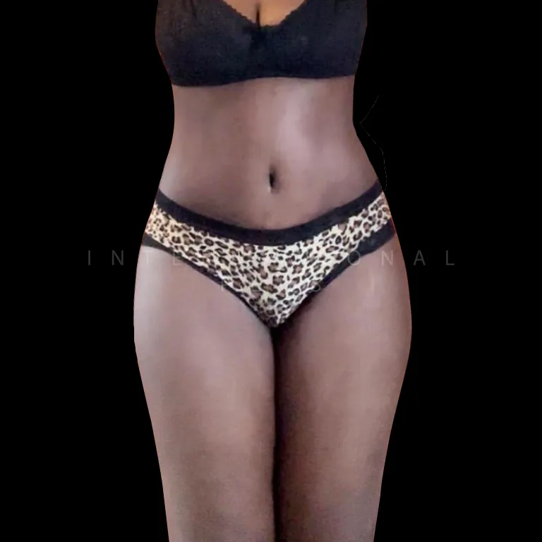 tummy tuck before after 22