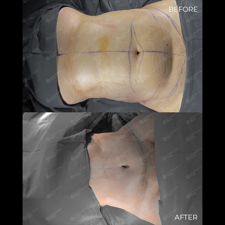 tummy tuck before after 34