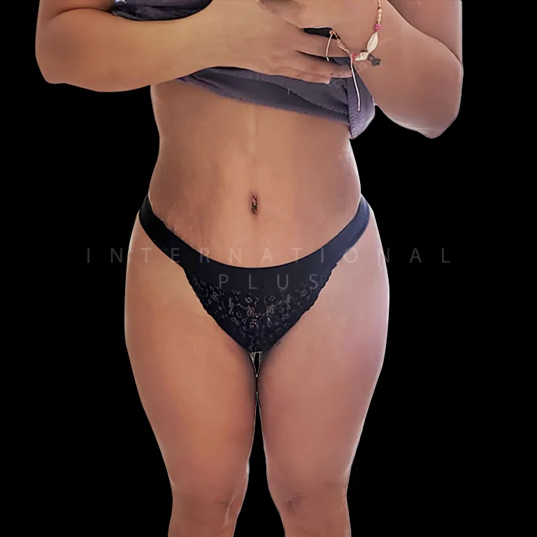 vaser-liposuction-before-after-10 vaser liposuction before after 10