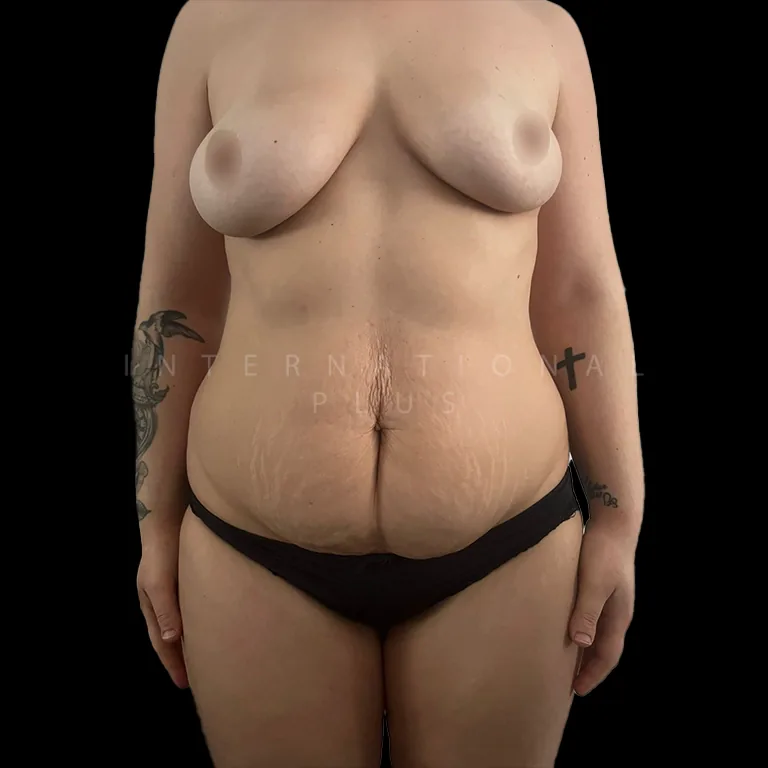 vaser-liposuction-before-after-13 vaser liposuction before after 13