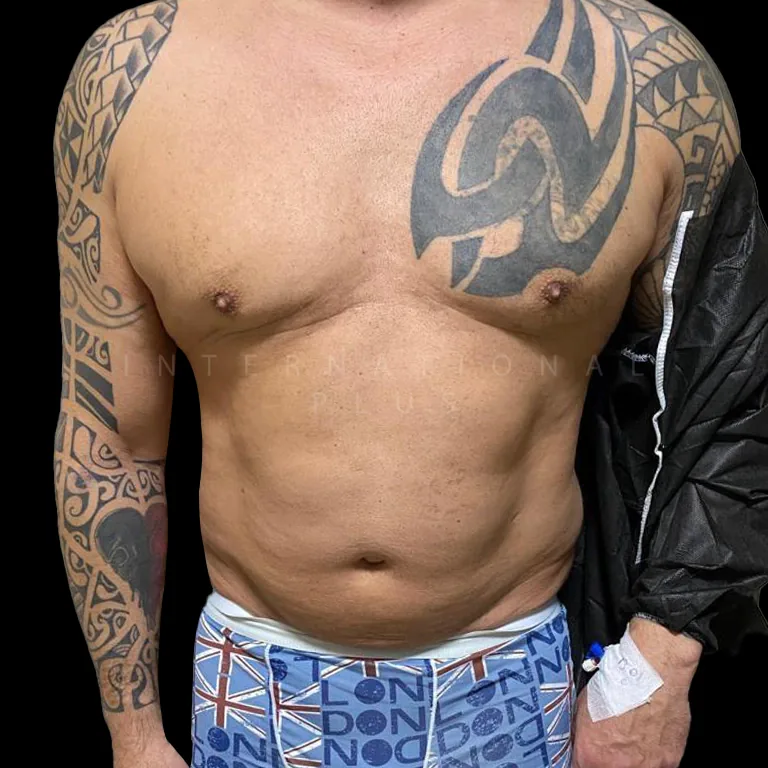vaser-liposuction-before-after-15 vaser liposuction before after 15