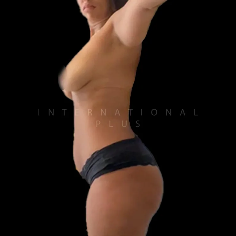 vaser-liposuction-before-after-5 vaser liposuction before after 5
