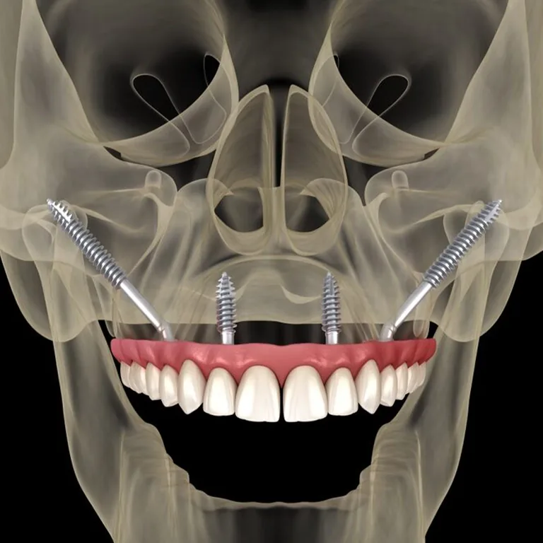 Zygomatic Implant (Before After)
