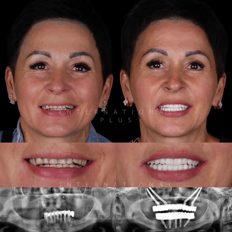 zygoma implant before after 8