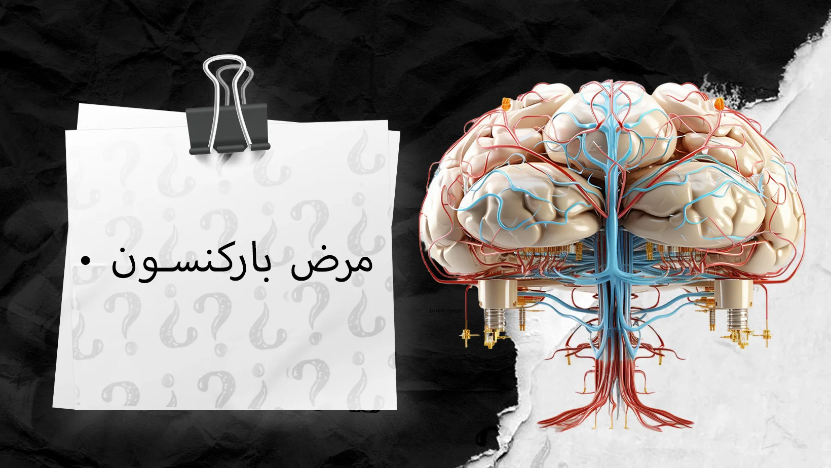 مرض-باركنسون