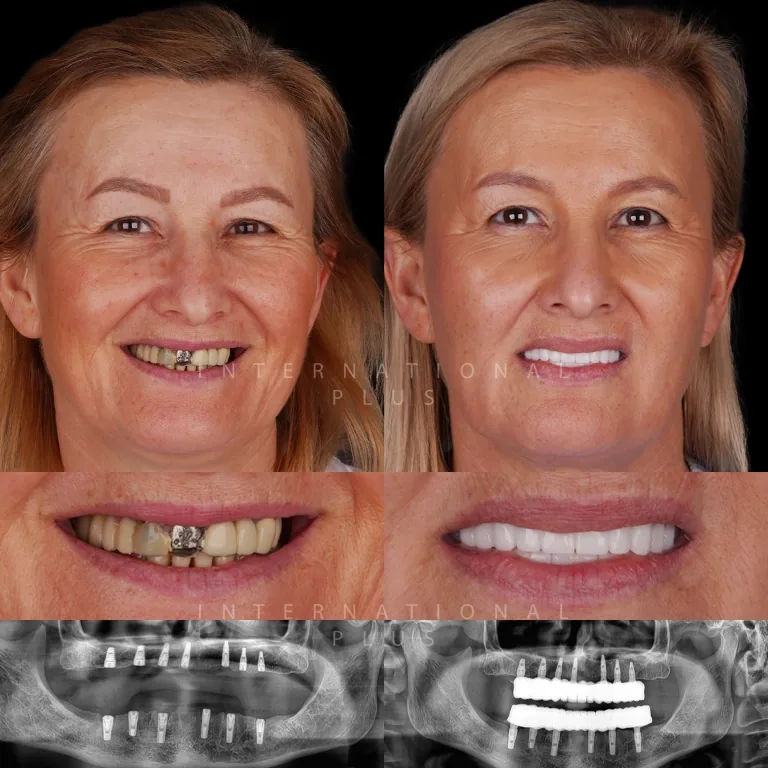 Advantages of Choosing Best Dental Implant Brands Bego Implant System for Tooth Replacement