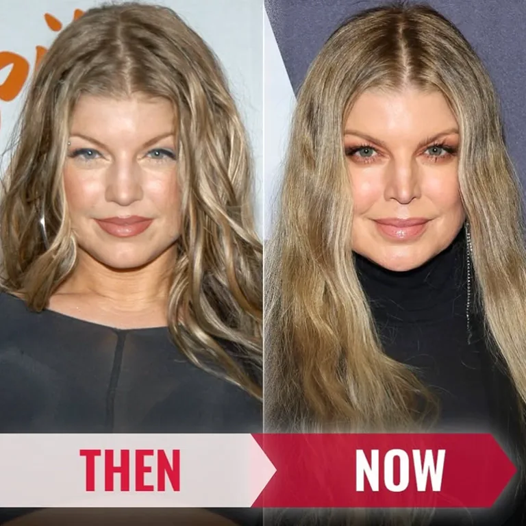 Fergie Facial Fillers and Her Secret to Youthful Skin