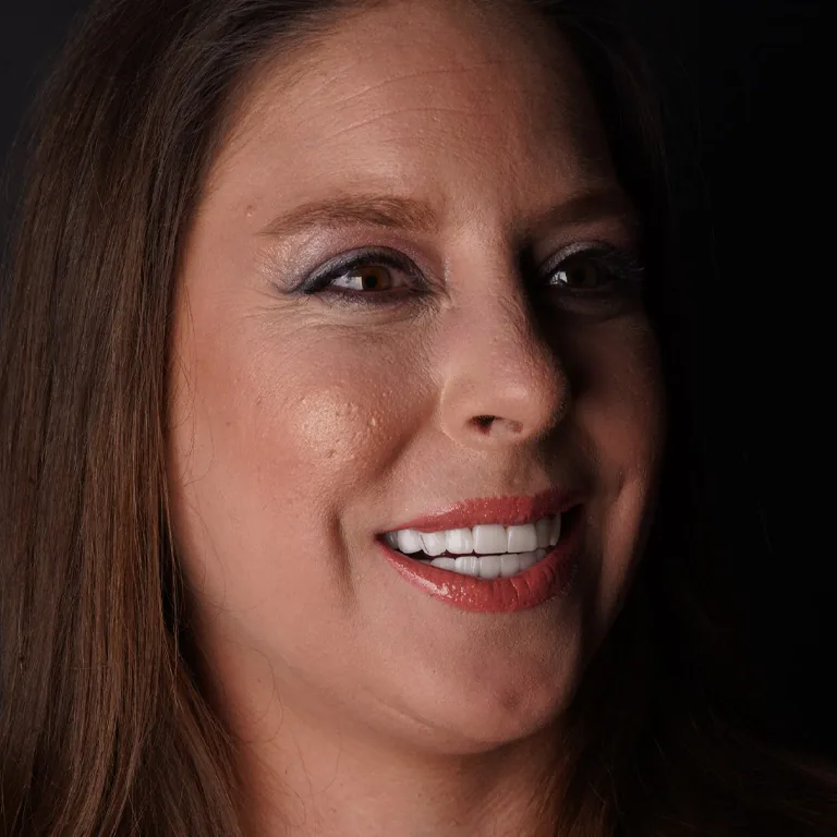 How Long Can You Expect Your Top Dental Implant to Last