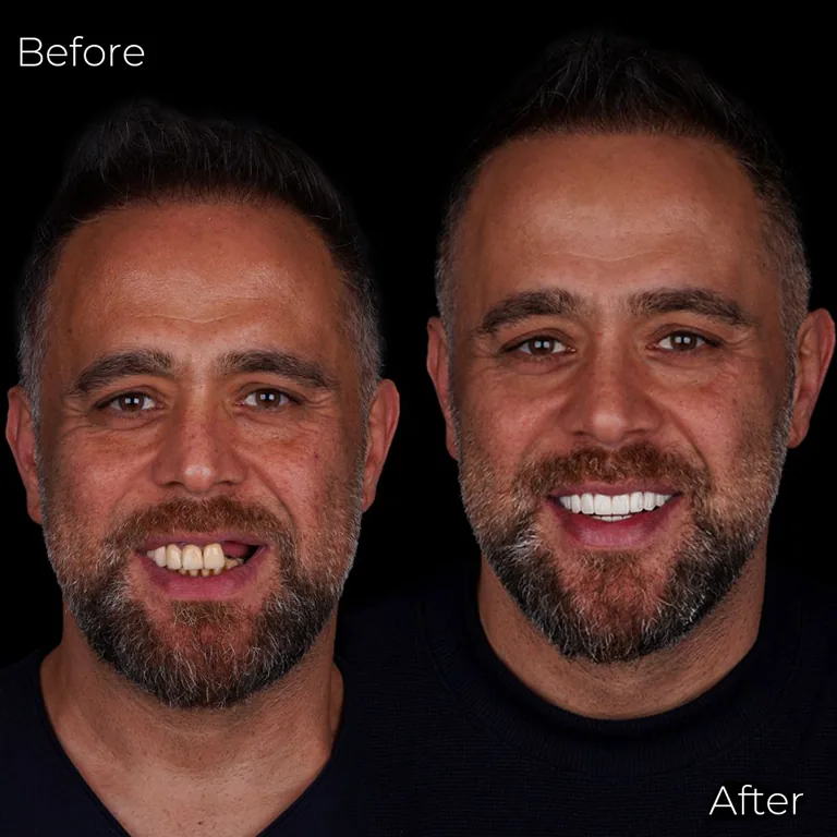 The Straumann Implant Placement Process What to Expect