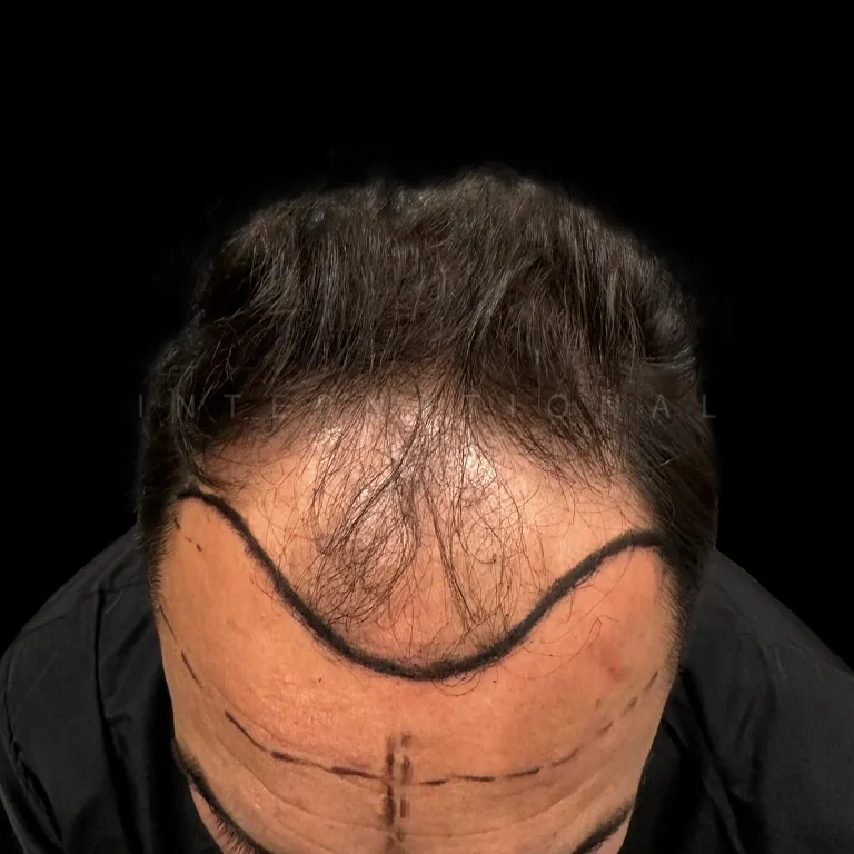 hair transplant before after 11