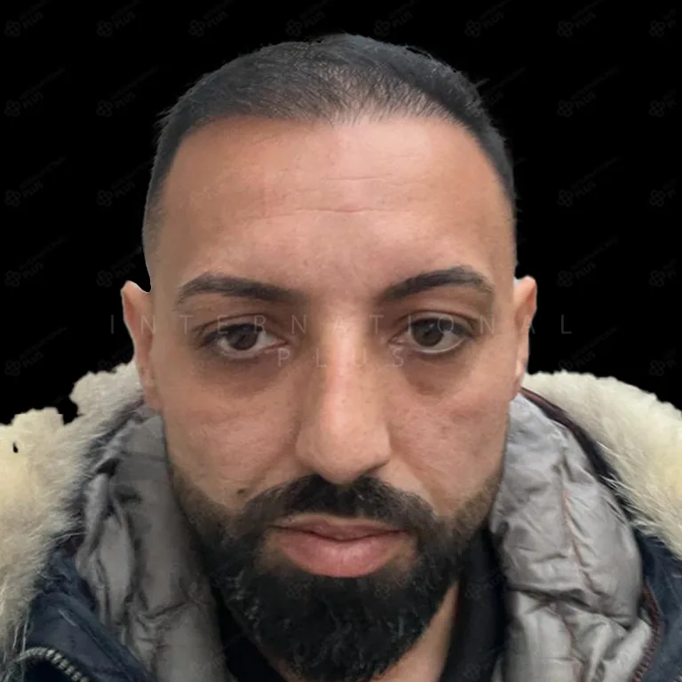 hair transplant before after 2