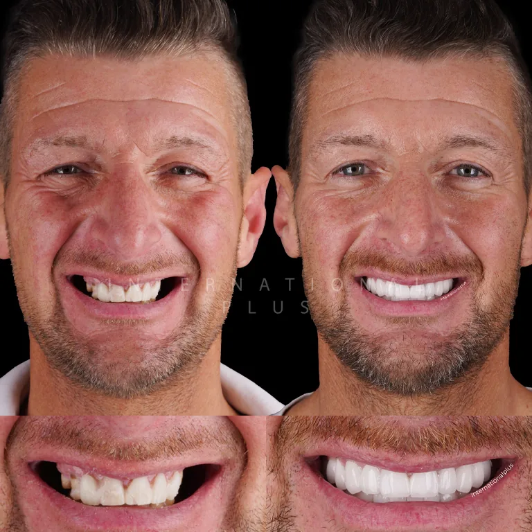Advantages of Choosing Swiss Implants for Your Dental Health and Patient Satisfaction