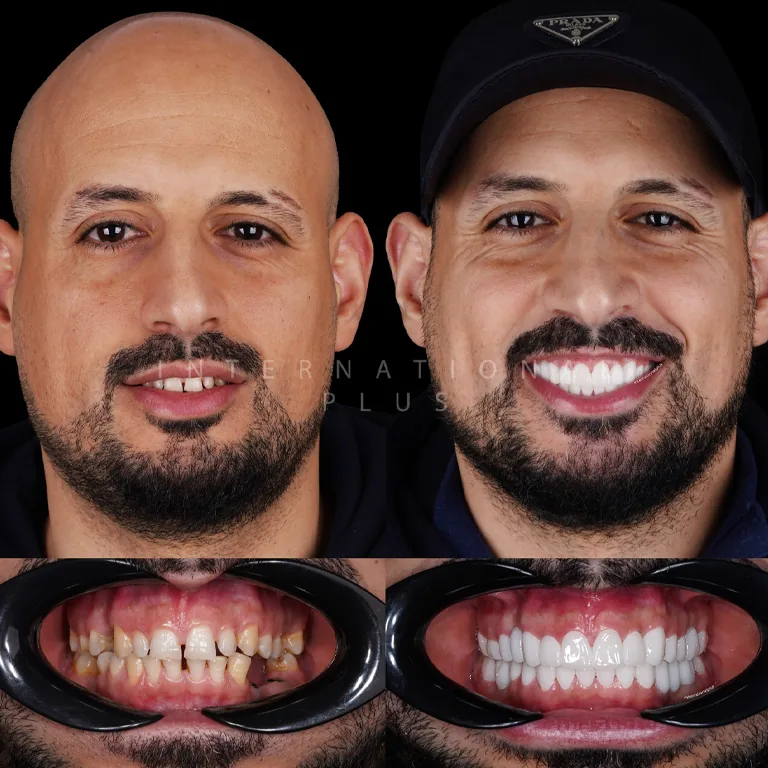 Are Implance Implants Suitable for Everyone Candidacy Criteria