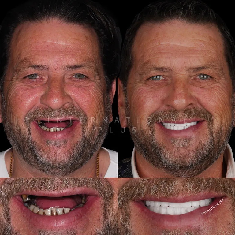 How Long Do Swiss Implants Last Longevity Insights