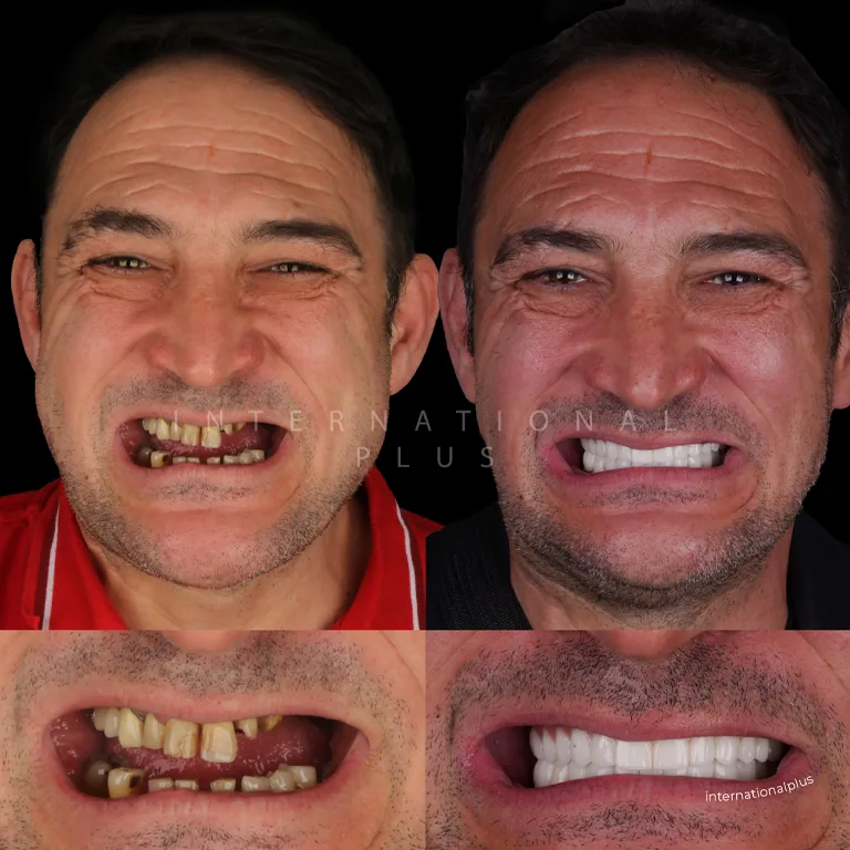 The Aesthetic Benefits of Swiss Implants in Smile Design