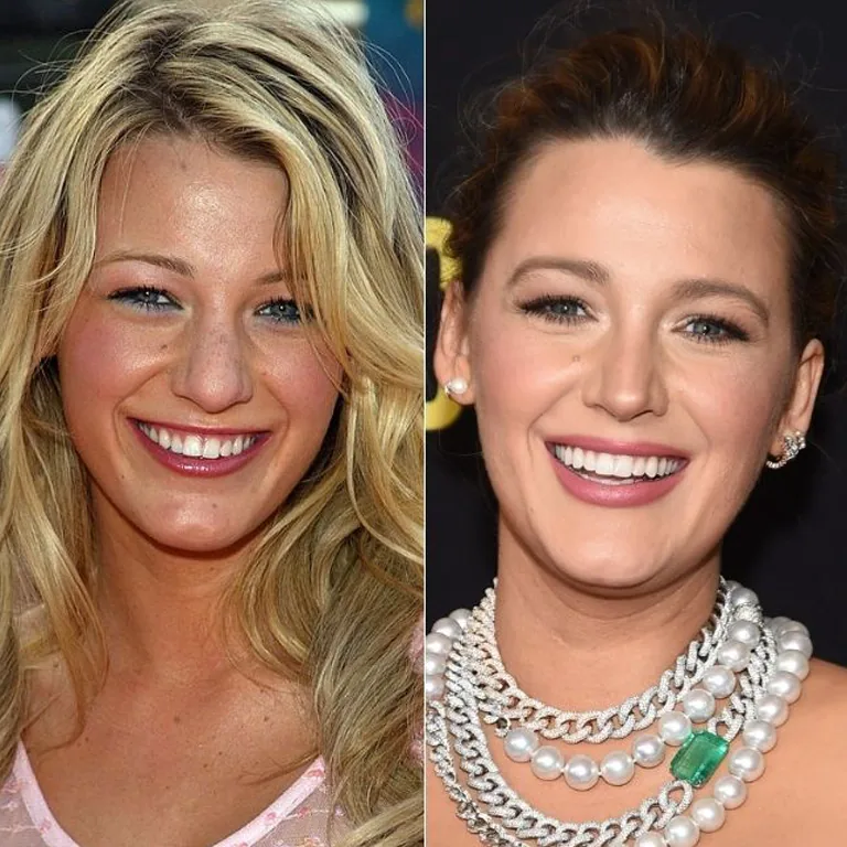 Who Is a Good Candidate for a Hollywood Smile Makeover and Celebrity Smile for Dental Health