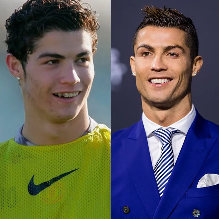 Cristiano Ronaldo Gum Line and Smile Design Did He Have Laser Gum Contouring