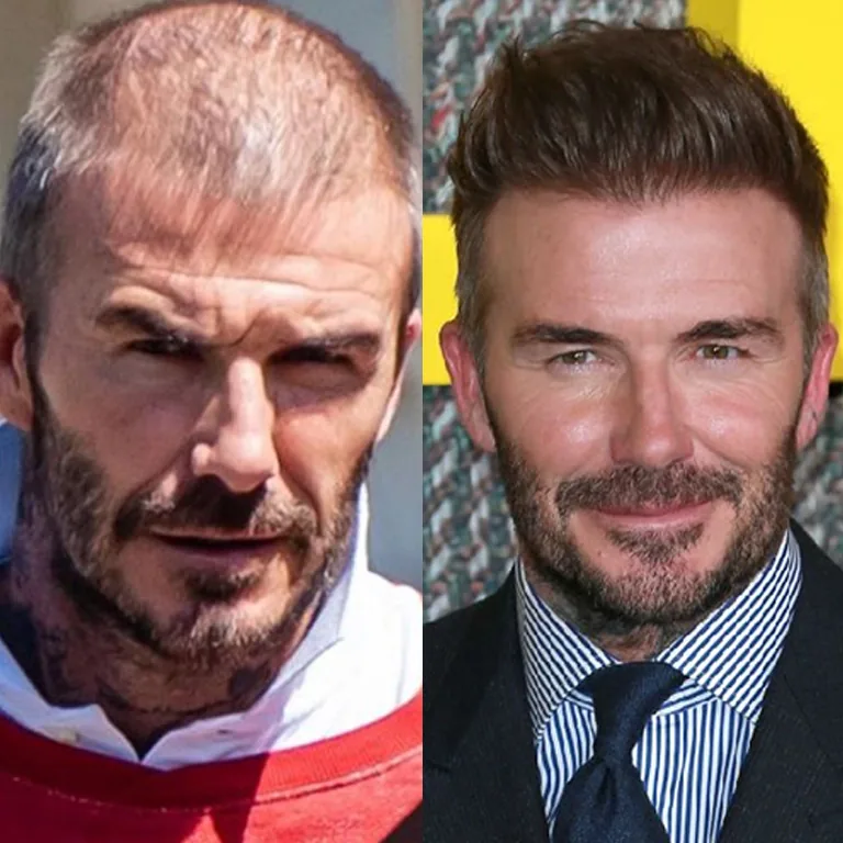 David Beckham Thinning Hair