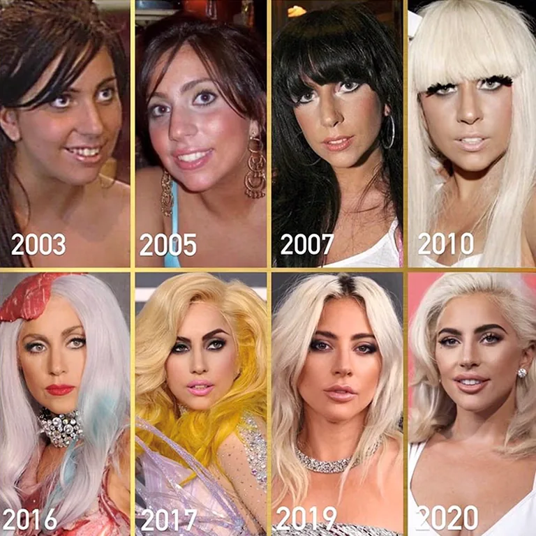 Did Lady Gaga Get Chin Implants for a More Defined Jawline