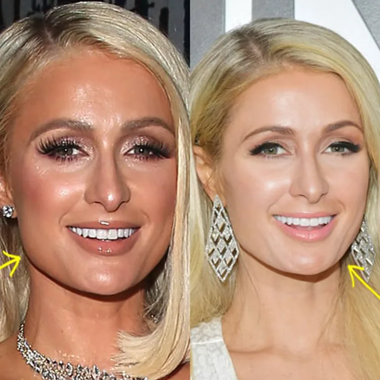 Did Paris Hilton Get Cheek Implants