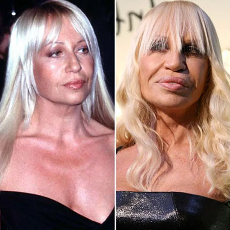 Donatella Versace Facelift A Tighter, Younger Look