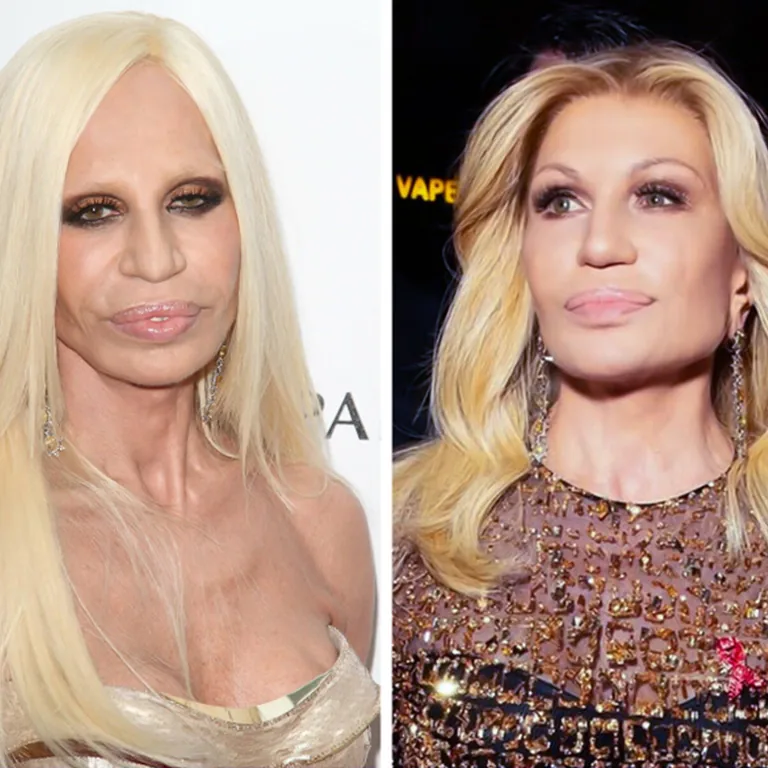 Donatella Versace Skin Laser Treatments, Chemical Peels, or Natural Aging