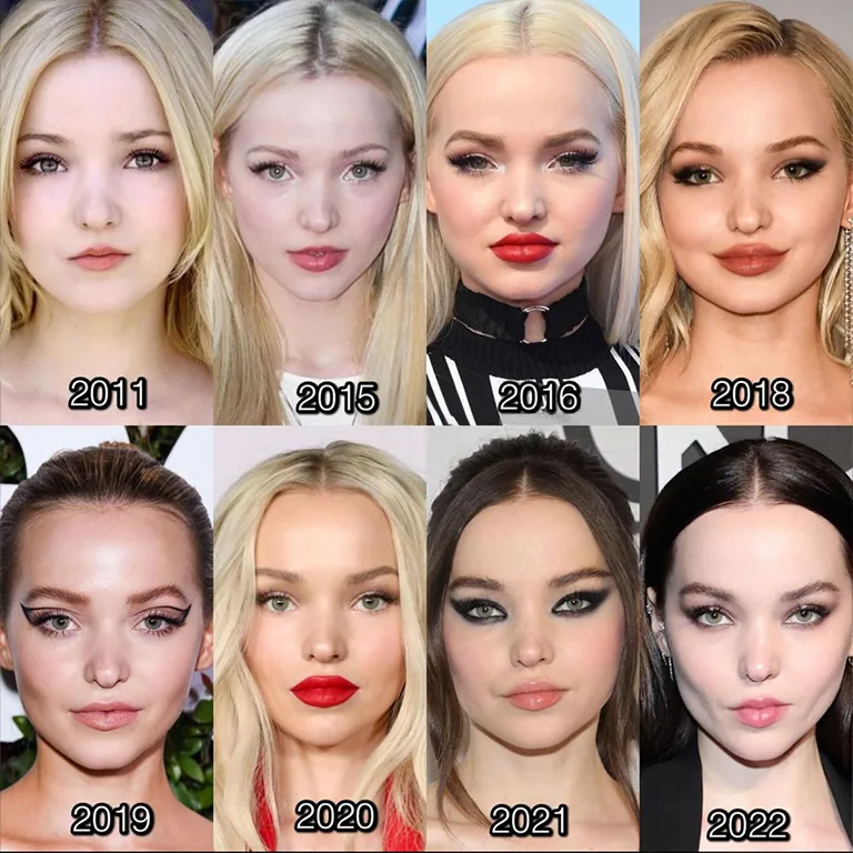 Dove Cameron Botox Smoothing the Lines