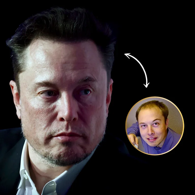 Elon Musk Hair Transplant