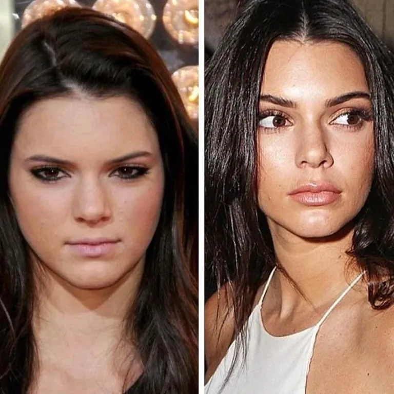 Kendall Jenner Nose Bridge and Tip Natural Refinement or Rhinoplasty