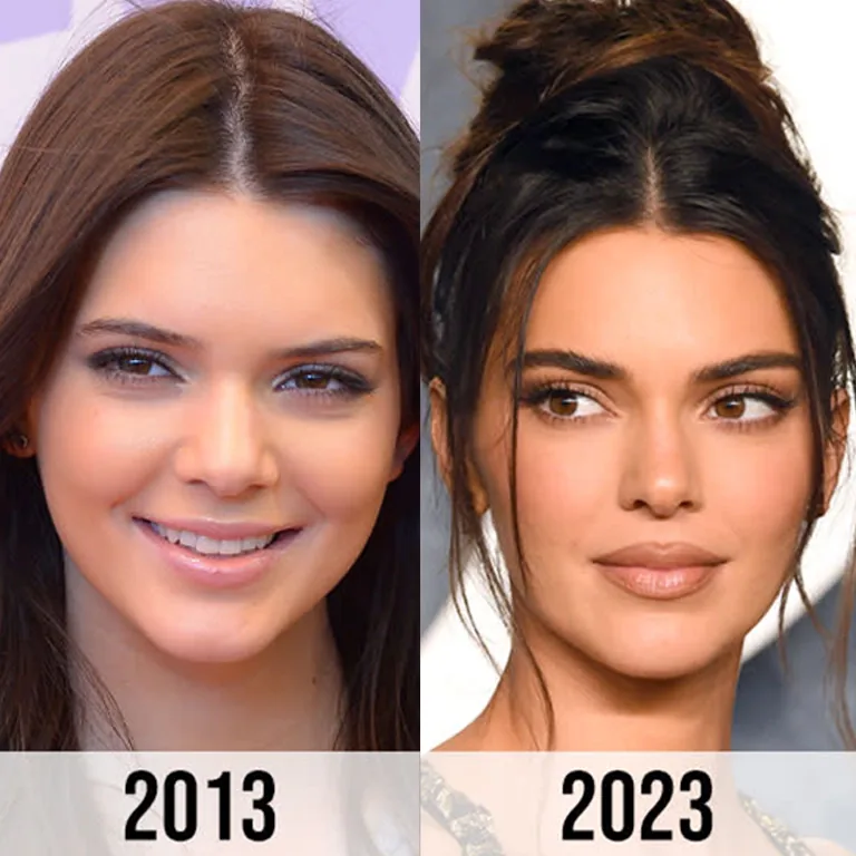 Kendall Jenner Nose Job vs. Natural Aging What Changed