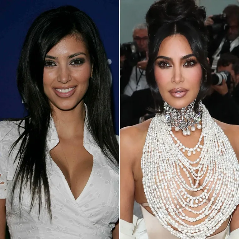 Kim Kardashian Botox
