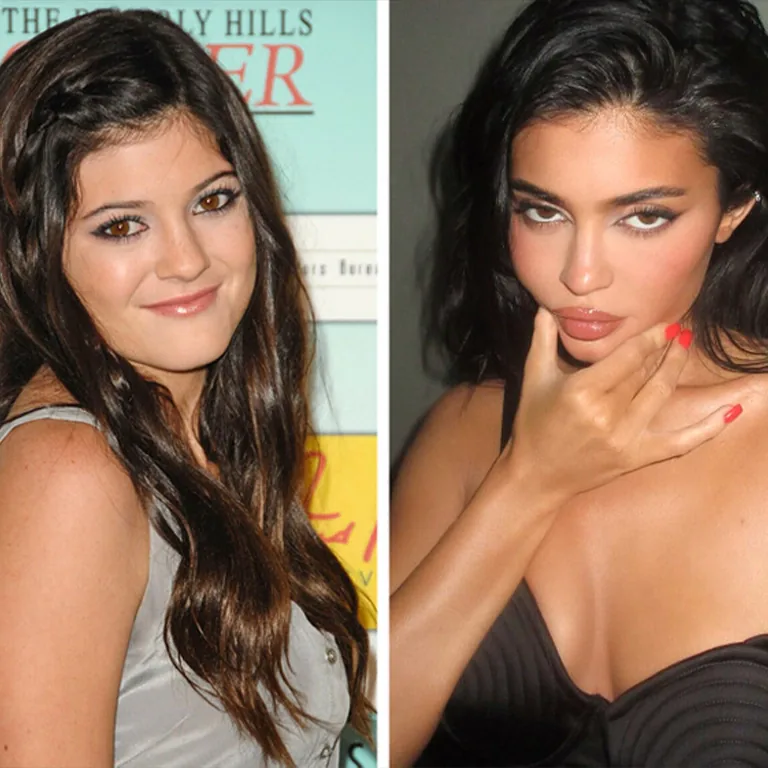 Kylie Jenner Botox
