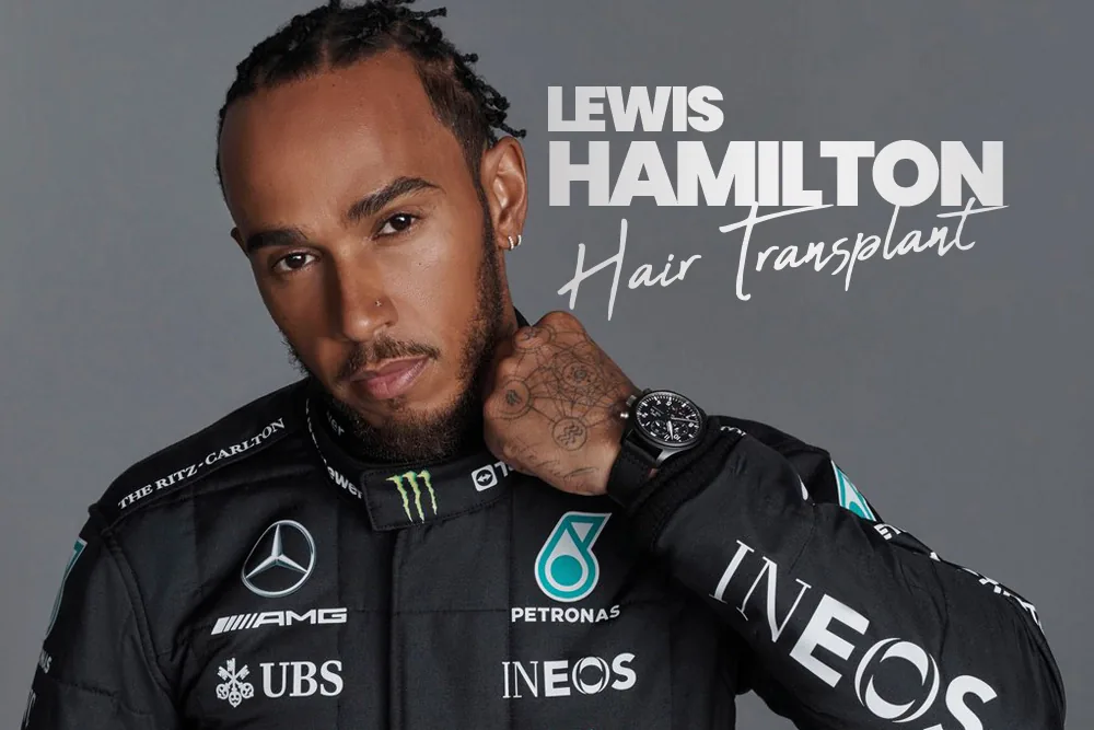 Lewis Hamilton Hair Transplant