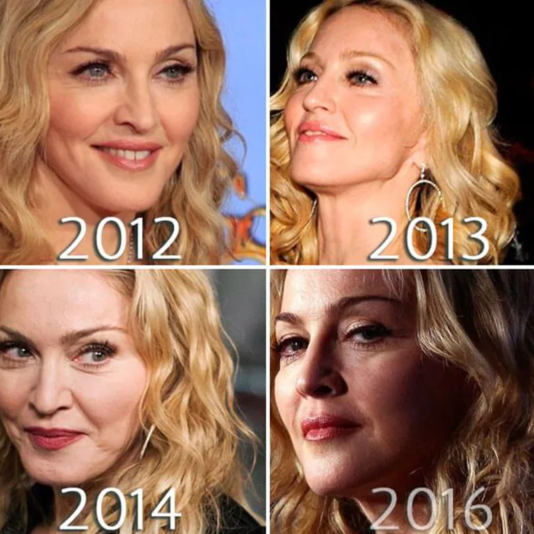 Madonna Eyebrow and Forehead Lift