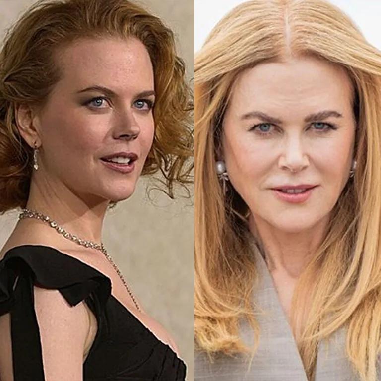 Nicole Kidman’s Jawline Transformation