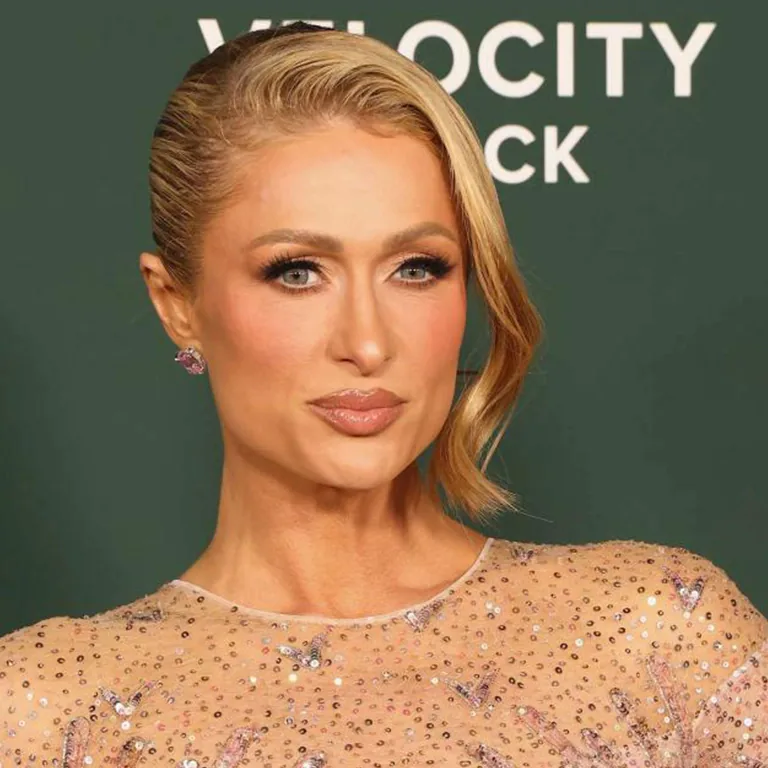Paris Hilton Cheek Filler vs Cheek Implants What’s the Difference