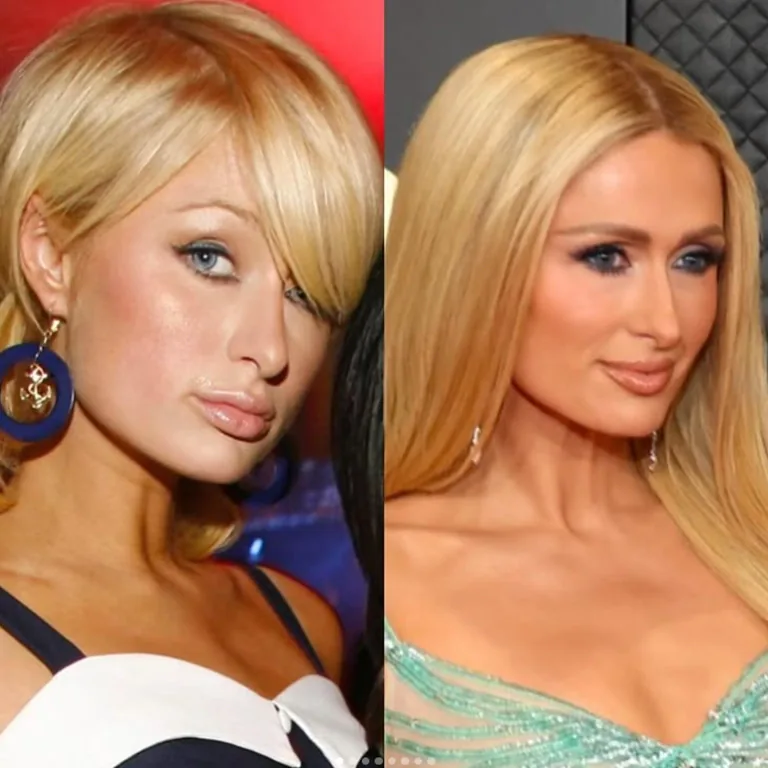 Paris Hilton’s Face Transformation A Timeline