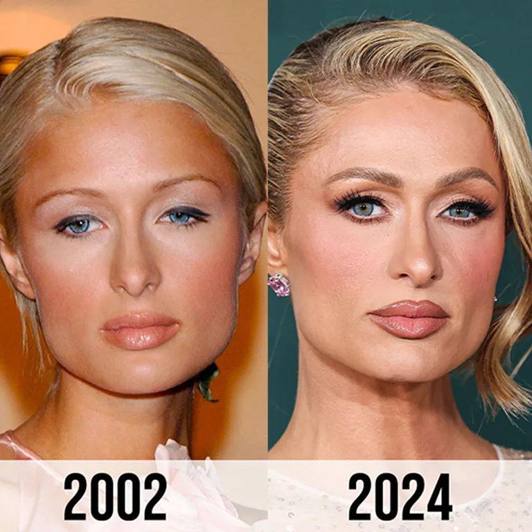 Paris Hilton’s Signature Look Natural Aging or Subtle Enhancements