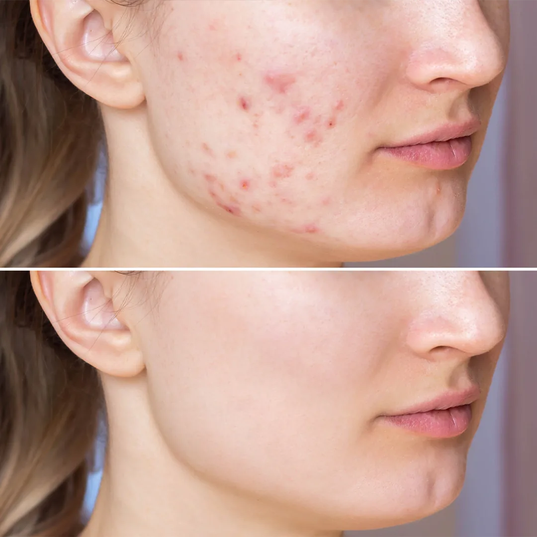 Advantages of EKSOZOM Treatment