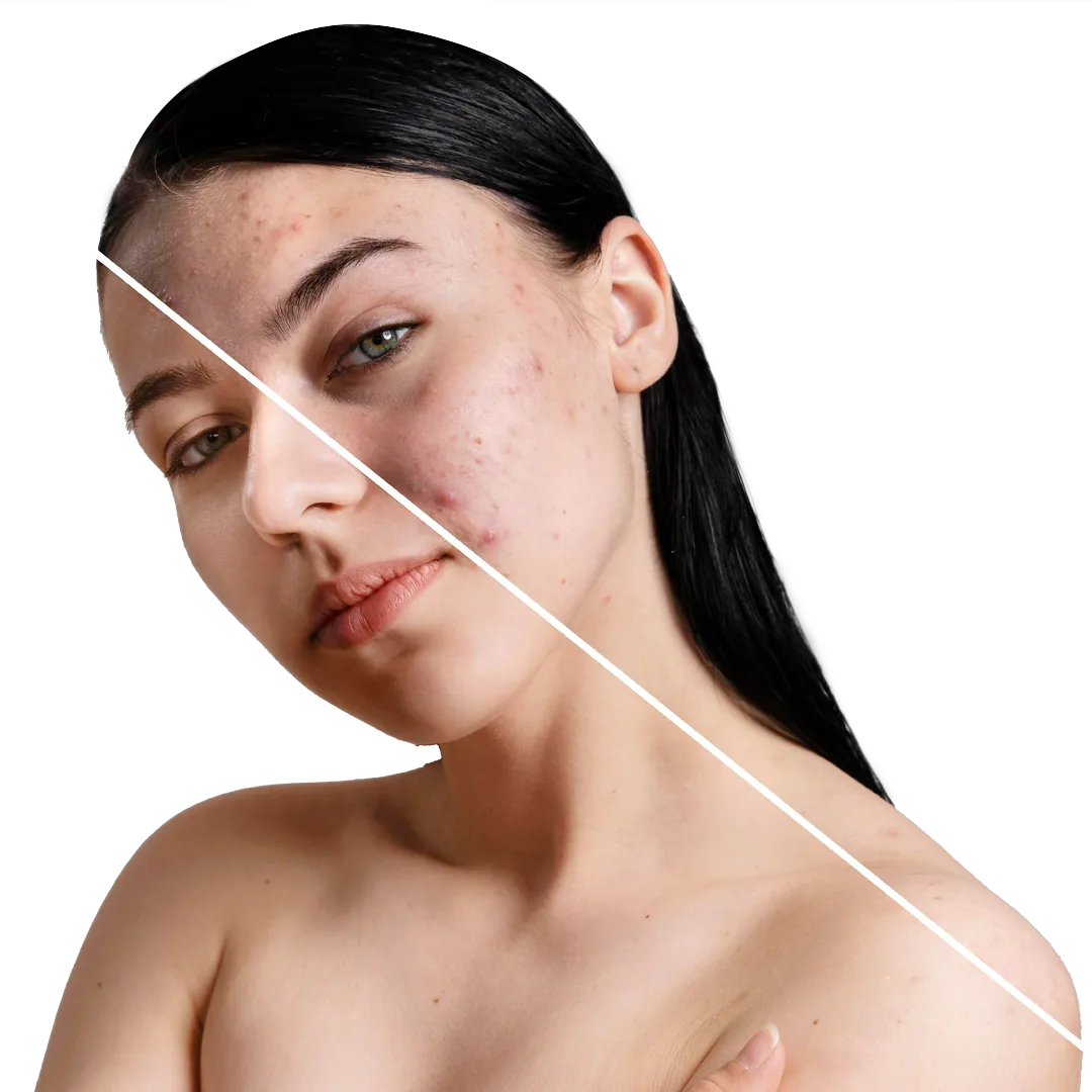 Advantages of HydraFacial Treatment