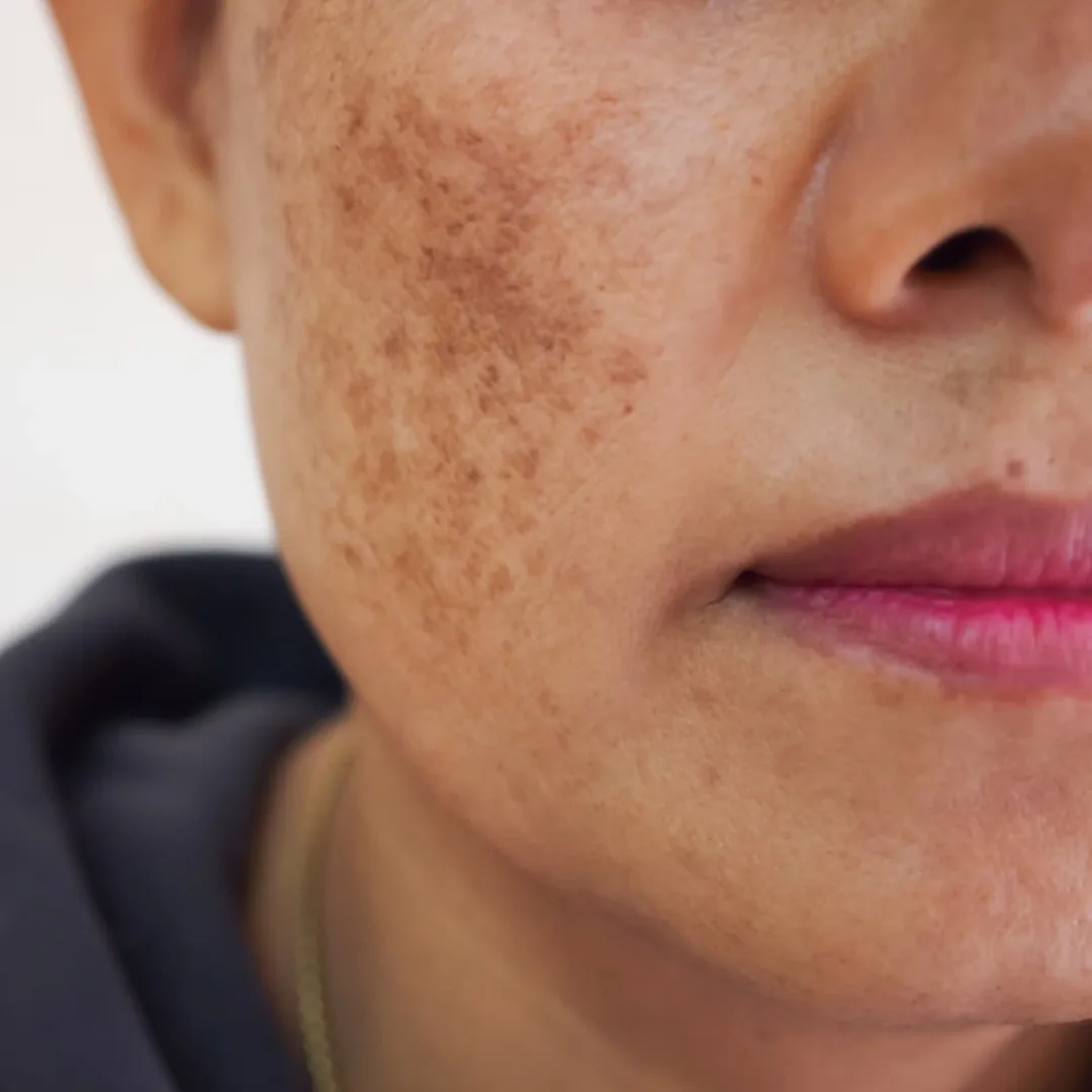 Advantages of TCA Peeling Treatment