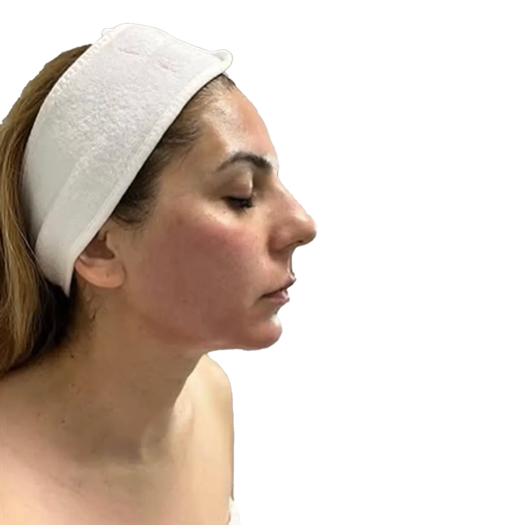 After PB Serum
