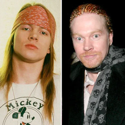 Axl Rose Before and After Facelift