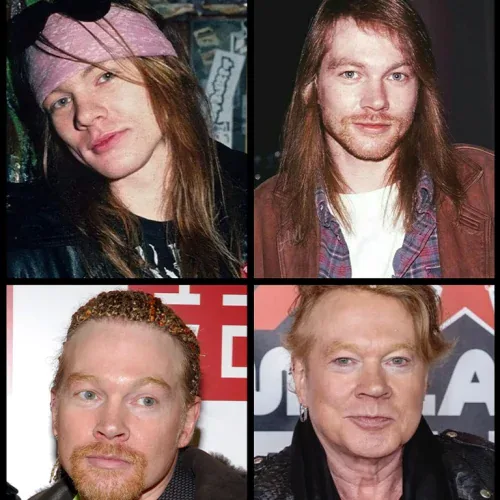 Axl Rose Face Transformation Over the Years