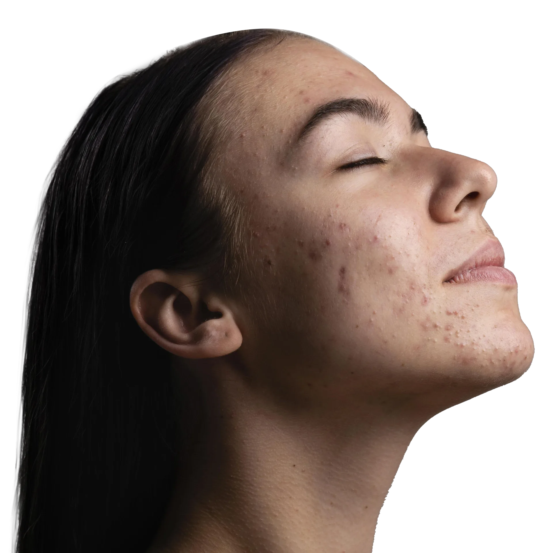 Before HydraFacial