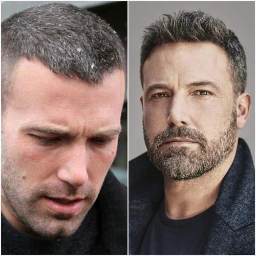 Ben Affleck Hair Restoration Journey