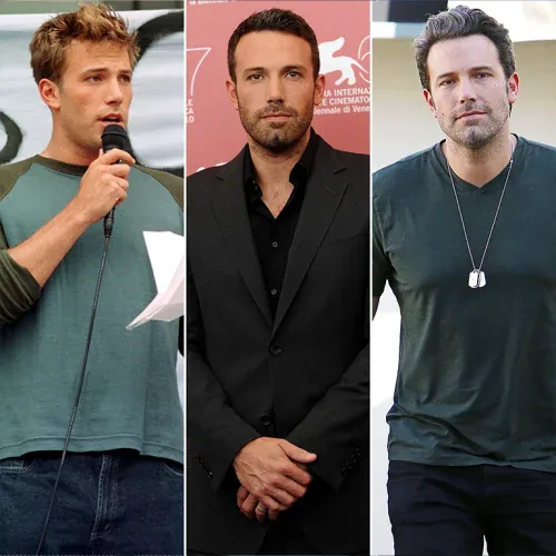 Ben Affleck Before and After Hair Transplant