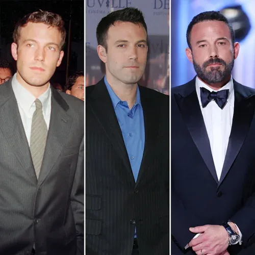 Ben Affleck Hair Transplant Results